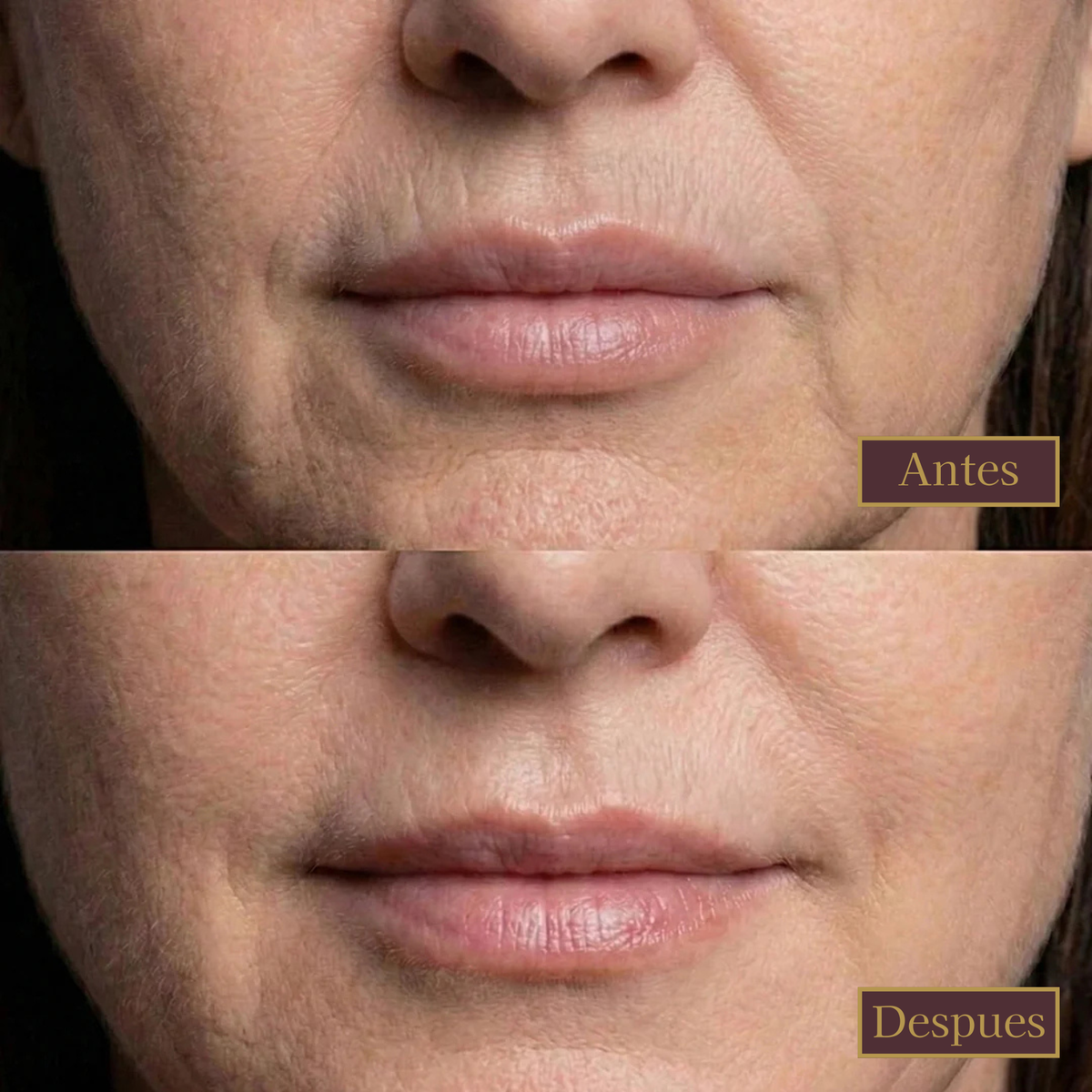 Pack MAXI de Parches Faciales de Silicona: Frente + Ojos + Boca y Labios